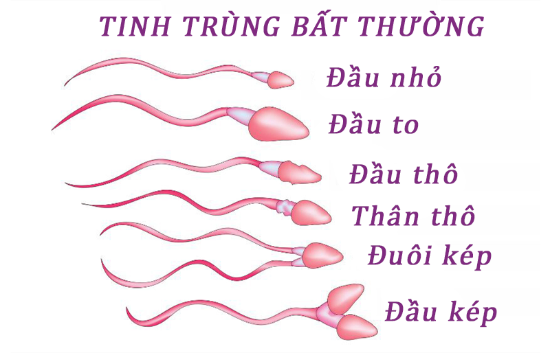 Nam giới có bất thường tinh trùng