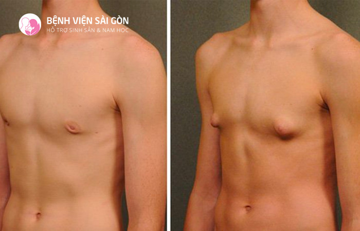 Hormone FSH tăng có gây ra hội chứng Klinefelter ở nam giới