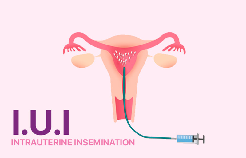 phương pháp thụ tinh nhân tạo (IUI)
