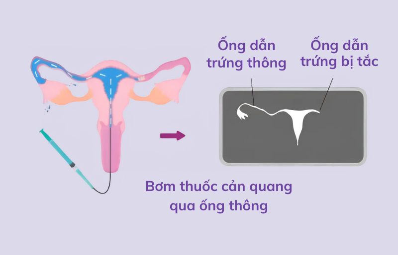 Quy tình chụp tử cung vòi trứng