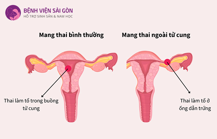 Nồng độ hCG không tăng như mong đợi và có thể ổn định khi mang thai ngoài tử cung