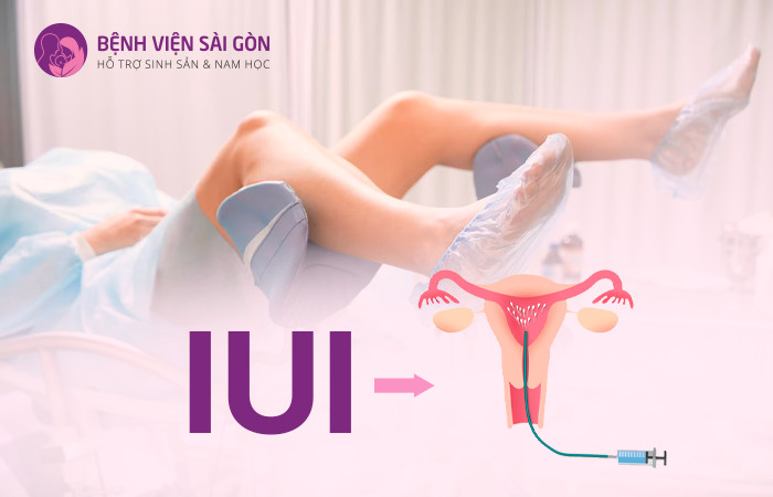 Thực hiện phương pháp IUI