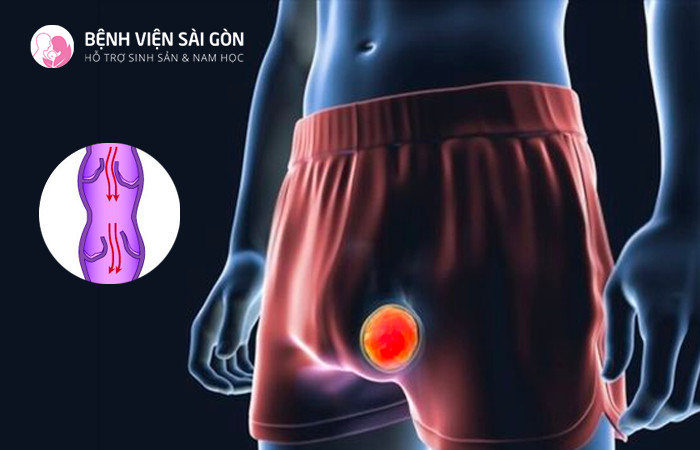 Giãn tĩnh mạch thừng tinh gây ra xuất tinh máu