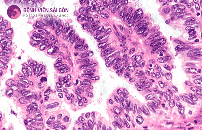 Ung thư biểu mô tuyến - Adenocarcinoma chiếm 20% tổng số ca bệnh ung thư cổ tử cung