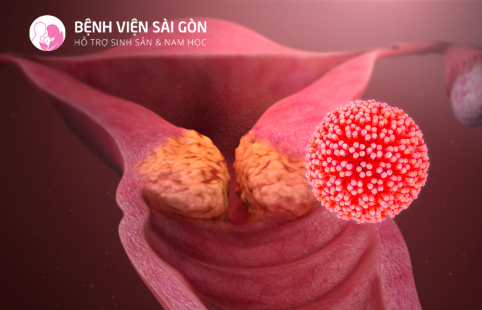 Ung thư cổ tử cung hiện đang trở nên phổ biến ở nữ giới