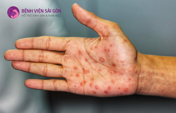 Nguyên nhân gây ra bệnh lây qua đường tình dục do vi khuẩn, virus và ký sinh trùng