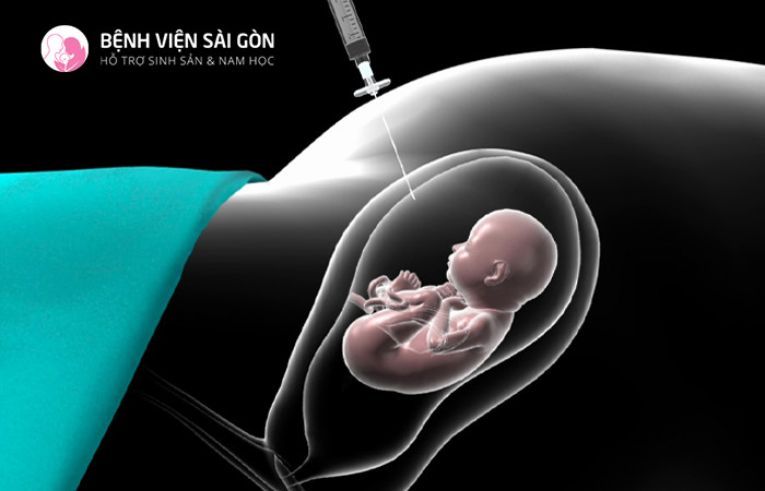 Chọc ối là phương pháp xác định chính xác nhất trong việc sàng lọc hội chứng Down