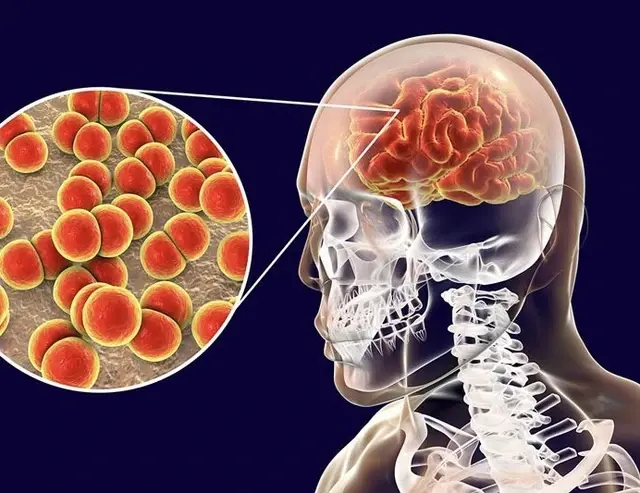 Bệnh não mô cầu do vi khuẩn Neisseria meningitidis gây ra